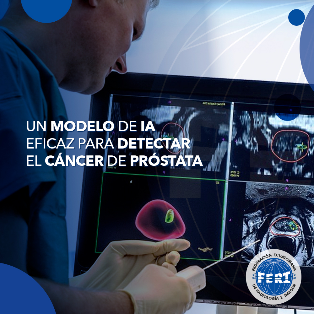 Un modelo de IA eficaz para detectar el cáncer de próstata